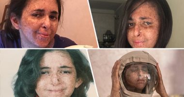 20 سنة مش عارفة تشوف الشمس.. مرض جلدى نادر تسبب فى ارتداء فتاة خوذة فضاء لحماية بشرتها من ضوء النهار.. فاطمة: اتحرمت من طفولتى ودراستى ونفسى أوعى الناس بالمرض.. ومش بخرج من البيت غير بالليل