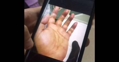 شوكة سمكة تصيب رجلا صينيا ببكتيريا خطيرة وتهدد ببتر يده.. اعرف التفاصيل "صورة"