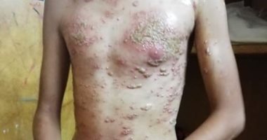 سيبها علينا.. قارئ من الأقصر يناشد الصحة لعلاج نجله من مرض جلدى نادر