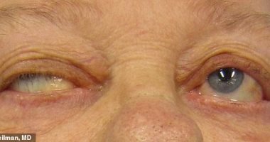 ديلى ميل: عدوى كورونا الشديدة تؤدى لمرض مناعى ذاتى يضعف العضلات