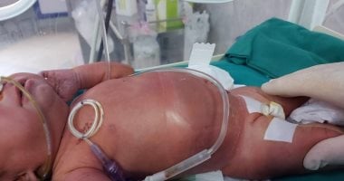 فريق طبى يجرى عملية اصلاح عيب خلقى بجدار البطن لطفلة برقعة من الحبل السرى 