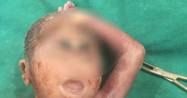 ولادة نادرة لطفل بـ"عين واحدة" وعيب خلقى فى المخ والقلب بالأقصر