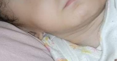 الصحة توجه الطفلة أمل لمستشفى أطفال مصر لمناظرة حالتها صباح الغد 