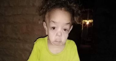 لجنة الاستغاثات الطبية بمجلس الوزراء تستجيب لعلاج الطفلة "ندى" من مدينة إسنا