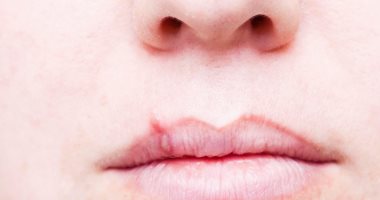 اطمن على نفسك.. متى يجب عمل تحليل فيروس الهربس EBV ؟