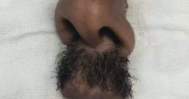قطع أنف مواطن فى مشاجرة بالأسلحة البيضاء بالغربية.. فيديو
