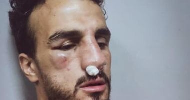 نزيف وكسر فى الأنف.. التشخيص المبدئى لإصابة مدافع الاتحاد بعد تدخل أحمد فتحى