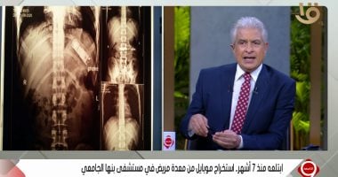 جراح بمستشفى بنها الجامعى يكشف كواليس استخراج موبايل من معدة مريض