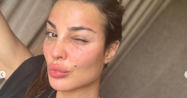 نادين نجيم x صور تبرز تغير وجهها بعد إصابتها بانفجار بيروت: شكراً يا رب على كل شىء