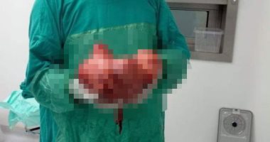 مستشفى إسنا يستأصل رحما متعدد الأورام الليفية بوزن 12 كيلو من سيدة