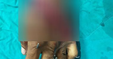 إعادة زرع كف يد شاب بعد بترها فى عملية ناجحة بجامعة طنطا.. صور