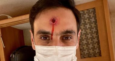 أحمد الشامى يداعب متابعيه بصورة رصاصة تخترق رأسه