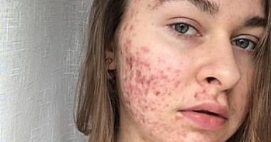 حب الشباب دمر حياتها .. أوكرانية تكشف قصة شفائها بعد 10 سنوات من المرض 