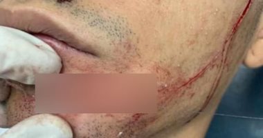 إصابة طالب فى مشاجرة بالأسلحة البيضاء بالمعادى