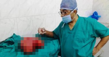استئصال ورم يزن 15 كيلو جرام من سيدة بمركز أورام طنطا .. صور