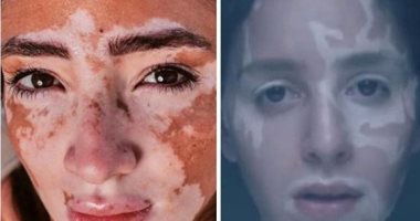 لوجينا صالح تستعرض قصتها مع البهاق بصورتين بعد نجاح "لازم اعيش"