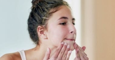 10 حيل سهلة للتخلص من الرؤوس البيضاء بالوجه.. خطواتها بسيطة