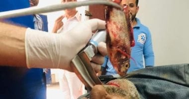 استخراج سمكة حية من داخل فم صياد بمستشفى بنى سويف التخصصى