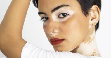 "فوتوسيشن" لدعم مرضى البهاق ومحاربة التنمر بإطلالة مميزة.. صور