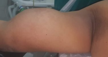 استئصال ورم ساركومى متضخم من ذراع مريض بمركز أورام طنطا.. صور