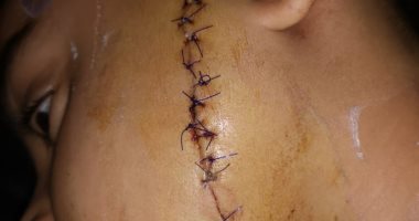 طفل يصيب طالبا بـ36 غرزة بموس حلاقة بالشرقية لمعايرته بطول أذنيه.. صور