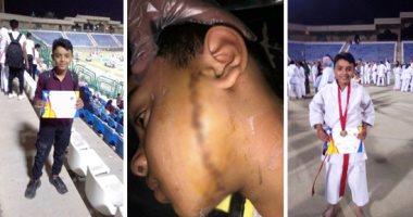 تفاصيل إصابة لاعب كاراتيه ناشئ بجروح استدعت 36 غرزة على يد صبى حلاق بالشرقية.. والد المجنى عليه: نجلى حاصل على بطولة الجمهورية.. وحالته سيئة لتشويه وجهه.. والحادثة أدت إلى تغيبه عن المدرسة.. صور