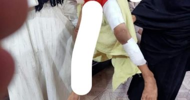 ربة منزل تتهم طليقها بتعذيب طفلته حرقا فى قنا 