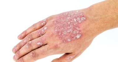 6 طرق للعلاجات المنزلية لمرض الصدفية.. منها اليوجا والشوفان 