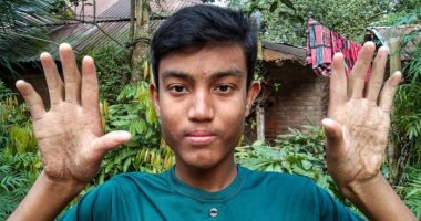 عائلة بدون بصمات يد ببنجلاديش.. اعرف حكايتهم مع الطفرات الجينية.. صور