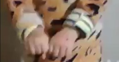 مدرّسة تحرق طفلة بسكين ساخن داخل حضانة لتبولها على نفسها بالغربية