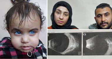صاحبة العيون الزرقاء.. "عليا" حملها والدها لتطعيمها فصدمه الطبيب بأنها لا ترى.. أجريت أكثر من عملية لها ولكنها فشلت.. وتحتاج زرع قرنية بالخارج.. ووالدتها: قلبى بيتقطع لما بشوفها وأناشد المسئولين تبنّى حالتها
