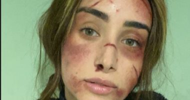 هنا الزاهد مازحة بوجه ممتلئ بالجروح والكدمات: شكلى من غير ميكب.. صورة