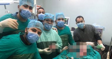 جراحة نادرة لاستئصال توأم مسخى ملتصق لطفلة لأم مصابة بكورونا بالمنيا