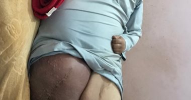 أوجاع عادل مع السمنة المفرطة.. وزنه 370 كيلو ويبحث عن العلاج بالغربية.. فيديو لايف