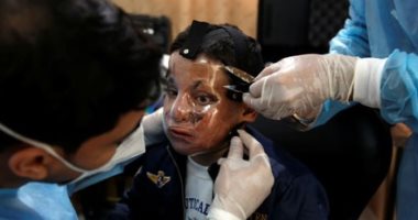 مفيش مستحيل .. أقنعة بطابعة ثلاثية الأبعاد تعيد الأمل لضحايا الحروق.. ألبوم صور