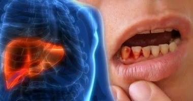 التهاب الكبد الدهنى.. نزيف اللثة علامة خطيرة على تفاقم المرض