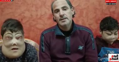 يوسف وأحمد طفلا المرض النادر يبدآن جراحات استئصال الأورام الخبيثة.. فيديو