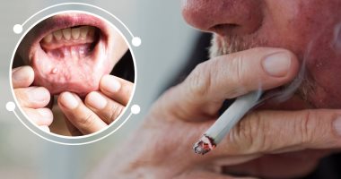 اليوم العالمي لصحة الفم.. كيف يتسبب التبغ فى الإصابة بسرطان الفم؟