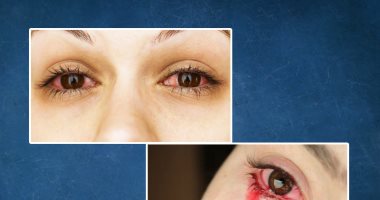 ما هى أسباب الحيض العيني؟..تعرف على مرض هيمولاكريا