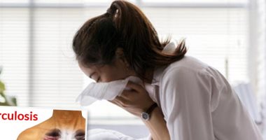العلاج بالأوزون يخفف أعراض السل ويمنع المضاعفات الناجمة عن المرض