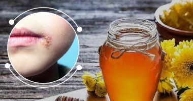 كل ما تريد معرفته عن أعراض وعلاج فيروس الهربس 