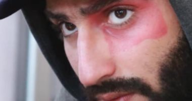 محمد الشرنوبى يوضح سر العلامة على وجهه فى "وكل ما نفترق": الناس فاكراها ضربة