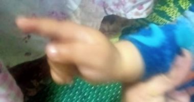 جامعة الزقازيق تستجيب لقارئة تستغيث لتركيب وتر صناعى بيد طفلتها