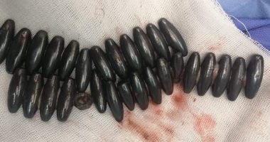 استخراج 30 صامولة ومغناطيس من معدة طفلة بمستشفيات جامعة الزقازيق
