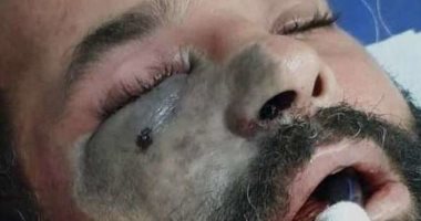 الصحة تكشف طرق الإصابة والعلاج من الفطر الأسود.. الوزارة: فترة العلاج من 4 لـ6 أسابيع وقد نضطر لاستئصال الأجزاء المصابة مثل الأنف والعين.. ومعدل الوفاة من 20 لـ50% للمصابين بأعراض شديدة.. و8 فئات معرضة للإصابة