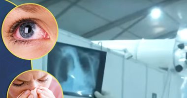 تعرف على أعراض الإصابة بداء الفطريات السوداء.. منها ألم فى الوجه
