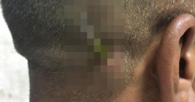 مستشفى سوهاج الجامعي ينجح في استخراج مفك طوله 10 سم من رأس مواطن.. صور