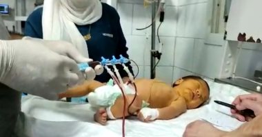 نجاح عملية تغيير دم كامل لطفل مبتسر فى الساعات الأولى من عمره بمستشفى شربين