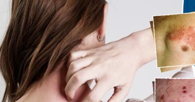 تعرف على أعراض وأسباب وعلاج الهربس النطاقى
