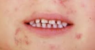 اعرفى ازاي تحمى طفلك من أمراض الصيف الشائعة وطرق علاجها